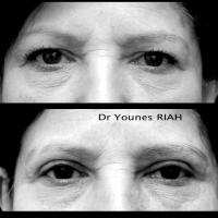 Blépharoplastie Dr Younes RIAH Chirurgie Esthétique