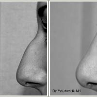 Rhinoplastie Dr Younes RIAH Chirurgie Esthétique