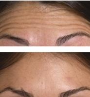 Injections Botox Dr Riah Younes Chirurgie