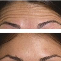 Injections Botox Dr Riah Younes Chirurgie