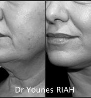 Lifting Dr Younes RIAH Chirurgie Esthétique