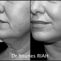 Lifting Dr Younes RIAH Chirurgie Esthétique