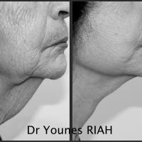 Lifting Dr Younes RIAH Chirurgie Esthétique