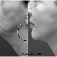 Lifting Dr Younes RIAH Chirurgie Esthétique