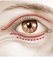 Blépharoplastie Dr Riah Younes Chirurgie