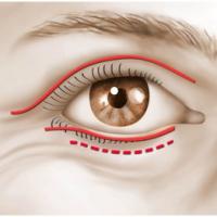 Blépharoplastie Dr Riah Younes Chirurgie