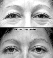 Blépharoplastie Dr Younes RIAH Chirurgie Esthétique