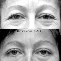 Blépharoplastie Dr Younes RIAH Chirurgie Esthétique