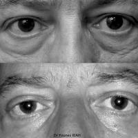 Blépharoplastie Dr Younes RIAH Chirurgie Esthétique