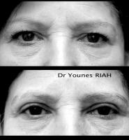 Blépharoplastie Dr Younes RIAH Chirurgie Esthétique