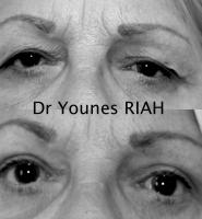 Blépharoplastie Dr Younes RIAH Chirurgie Esthétique