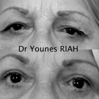 Blépharoplastie Dr Younes RIAH Chirurgie Esthétique