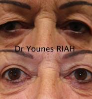 Blépharoplastie Dr Younes RIAH Chirurgie Esthétique