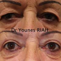 Blépharoplastie Dr Younes RIAH Chirurgie Esthétique