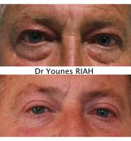 Blépharoplastie Dr Younes RIAH Chirurgie Esthétique