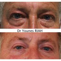 Blépharoplastie Dr Younes RIAH Chirurgie Esthétique