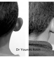Otoplastie Dr Younes RIAH Chirurgie Esthétique