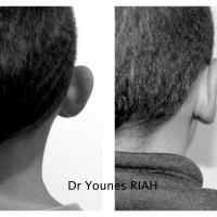 Otoplastie Dr Younes RIAH Chirurgie Esthétique