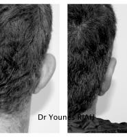 Otoplastie Dr Younes RIAH Chirurgie Esthétique