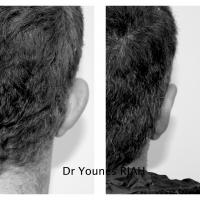 Otoplastie Dr Younes RIAH Chirurgie Esthétique