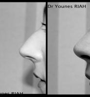 Rhinoplastie Dr Younes RIAH Chirurgie Esthétique