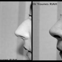 Rhinoplastie Dr Younes RIAH Chirurgie Esthétique