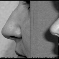 Rhinoplastie Dr Younes RIAH Chirurgie Esthétique