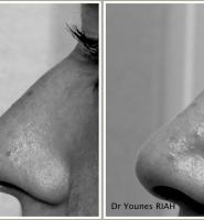 Rhinoplastie Dr Younes RIAH Chirurgie Esthétique