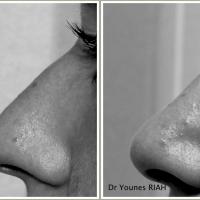 Rhinoplastie Dr Younes RIAH Chirurgie Esthétique