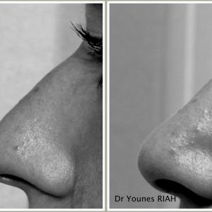 Rhinoplastie