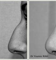 Rhinoplastie Dr Younes RIAH Chirurgie Esthétique