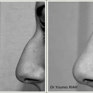 Rhinoplastie