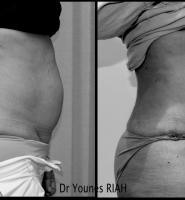 Liposuccion Dr Younes RIAH Chirurgie Esthétique