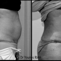 Liposuccion Dr Younes RIAH Chirurgie Esthétique