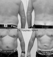 Liposuccion Dr Younes RIAH Chirurgie Esthétique