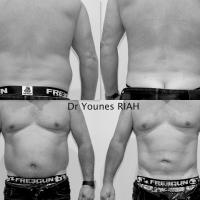 Liposuccion Dr Younes RIAH Chirurgie Esthétique