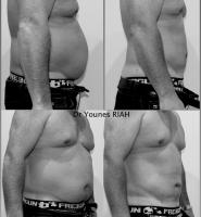 Liposuccion Dr Younes RIAH Chirurgie Esthétique