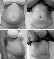 Abdominoplastie Dr Younes RIAH Chirurgie Esthétique