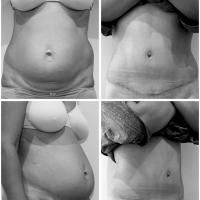 Abdominoplastie Dr Younes RIAH Chirurgie Esthétique