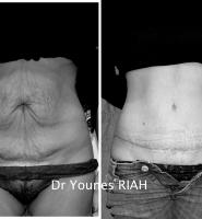 Abdominoplastie Dr Younes RIAH Chirurgie Esthétique