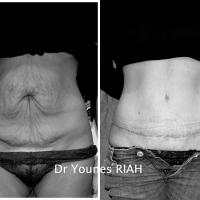 Abdominoplastie Dr Younes RIAH Chirurgie Esthétique