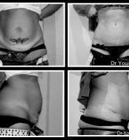 Abdominoplastie Dr Younes RIAH Chirurgie Esthétique