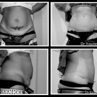 Abdominoplastie Dr Younes RIAH Chirurgie Esthétique