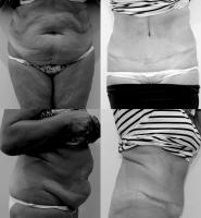 Abdominoplastie Dr Younes RIAH Chirurgie Esthétique