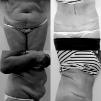 Abdominoplastie Dr Younes RIAH Chirurgie Esthétique