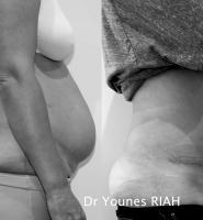 Abdominoplastie Dr Younes RIAH Chirurgie Esthétique