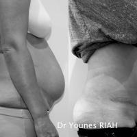 Abdominoplastie Dr Younes RIAH Chirurgie Esthétique
