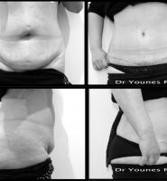 Abdominoplastie Dr Younes RIAH Chirurgie Esthétique