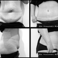 Abdominoplastie Dr Younes RIAH Chirurgie Esthétique