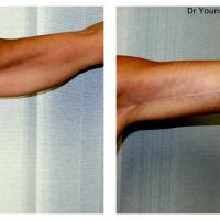 Lifting des bras & des cuisses Dr Younes RIAH Chirurgie Esthétique